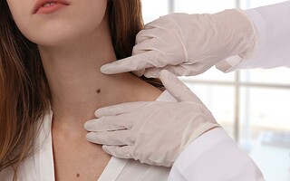 Grains de beauté à surveiller : quels gestes adopter ?