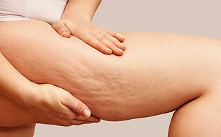 Reconnaître son type de cellulite pour mieux la traiter