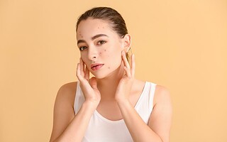 L'acné de l'adulte : de quoi parle-t-on ?
